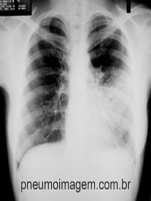 APNEIA DO SONO AUMENTA O RISCO DE PNEUMONIA EM ADULTOS